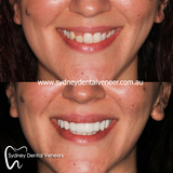 Midline shift disguise and masking asymmetry. Surprisingly challenging but we have some success.

#smilemakeover
#dentalveneers
#cosmeticdentist #cosmeticdentistry #emax, Sydney Dental Veneer, Sydney