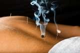 Patient receiving acupuncture treatment to his back Acupuncture & Alternative Health Care Concepts,Inc. 10645 Riverside Drive 