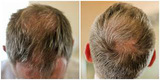 Meraki Hair Loss Clinic - Hair Loss Treatment Brisbane, Underwood