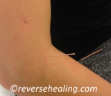Physio Acupuncture Reverse Healing 69 Rosemary Avenue 