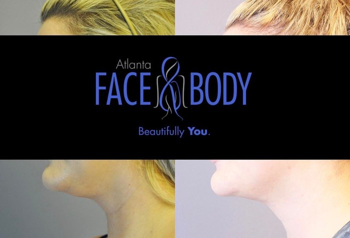  Profile Photos of Atlanta Face & Body 3200 Cobb Galleria Parkway, Suite 205 - Photo 6 of 7