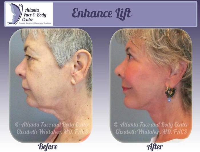  Profile Photos of Atlanta Face & Body 3200 Cobb Galleria Parkway, Suite 205 - Photo 7 of 7