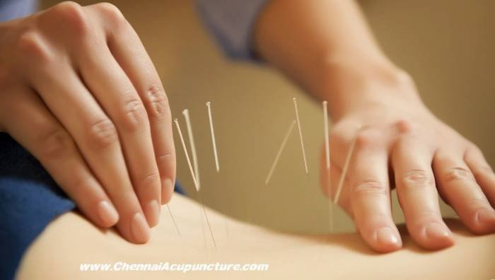  Profile Photos of Chennai Jayanth Acupuncture Clinic # 33/18, 1st Floor, School Street, Next to Mahindra First Choice - Photo 3 of 3