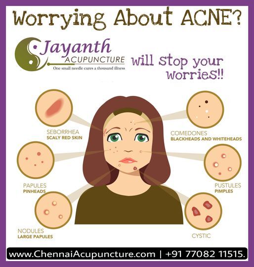Acupuncture Treatment for Acne-Pimples Acupuncture Treatment Near Me of Chennai Jayanth Acupuncture Clinic # 33/18, 1st Floor, School Street, Next to Mahindra First Choice - Photo 10 of 27