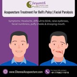 Acupuncture Treatment For Bells Palsy - Facial Paralysis in Chennai Chennai Jayanth Acupuncture Clinic # 33/18, 1st Floor, School Street, Next to Mahindra First Choice 