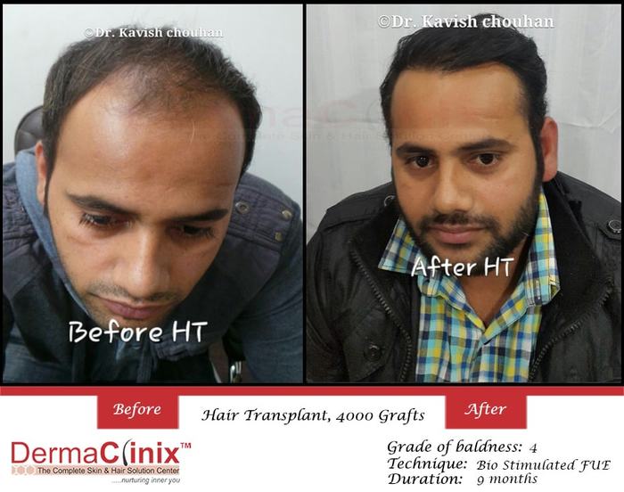  Hair Transplant of DermaClinix - The Complete Skin & Hair Solution Center E-13, Basement, Defence Colony, Near Andrews Ganj Bus Stop, New Delhi - Photo 2 of 8