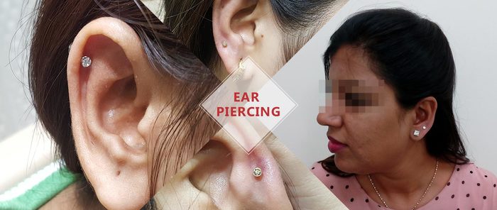  Hair Transplant of DermaClinix - The Complete Skin & Hair Solution Center E-13, Basement, Defence Colony, Near Andrews Ganj Bus Stop, New Delhi - Photo 5 of 8
