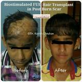  DermaClinix - The Complete Skin & Hair Solution Center E-13, Basement, Defence Colony, Near Andrews Ganj Bus Stop, New Delhi 
