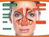 sinus surgery, AllergyDoc, Gurgaon