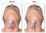 Thyroid surgery, AllergyDoc, Gurgaon