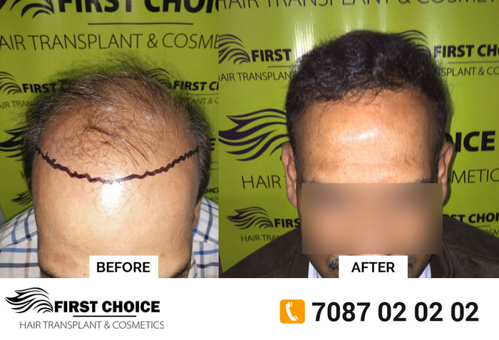  Hair Transplant Results of First Choice Hair Transplant & Cosmetics #21, First Floor, Phase 1 Rd,  Main Market, Urban Estate Dugri, Ludhiana - Photo 1 of 5