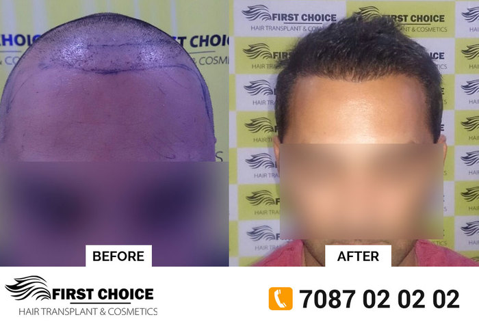  Hair Transplant Results of First Choice Hair Transplant & Cosmetics #21, First Floor, Phase 1 Rd,  Main Market, Urban Estate Dugri, Ludhiana - Photo 4 of 5