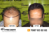  First Choice Hair Transplant & Cosmetics #21, First Floor, Phase 1 Rd,  Main Market, Urban Estate Dugri, Ludhiana 