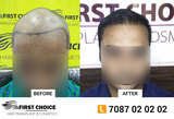 First Choice Hair Transplant & Cosmetics, Ludhiana