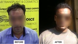 First Choice Hair Transplant & Cosmetics, Ludhiana