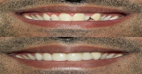  Pricelists of Dental Veneers & Lumineers 1603 McDonald Ave #345 - Photo 4 of 4