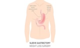  Gastric Sleeve Surgery 100 Beekman Street, # 12E 