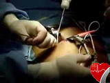 Low Cost ICD Implantation India packages for Uganda patients, Uganda