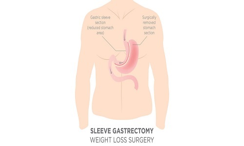  New Album of Gastric Sleeve Surgery 71 Carroll Street - Photo 3 of 5