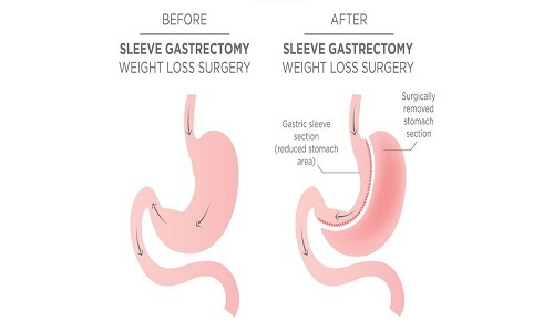  New Album of Gastric Sleeve Surgery 71 Carroll Street - Photo 4 of 5