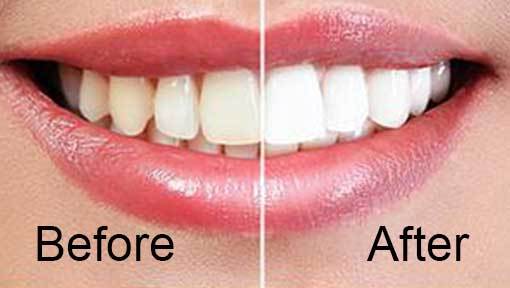  Profile Photos of Teeth Whitening Tools 1, 5 Trafalgar St - Photo 3 of 3