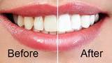 Teeth Whitening Tools, Brighton-Le-Sands