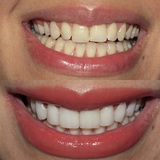 Best Dental Implants, Brooklyn