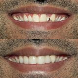 Best Dental Implants, Brooklyn