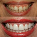Best Dental Implants, Brooklyn