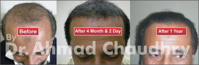  Profile Photos of Cosmo Hair transplant Clinic Lahore 31 A- Ali Zeb Road Block C- 3 Gulberg-3 Firdous Market â€“ opposite Total Pump - Photo 1 of 2