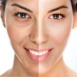 laser photo rejuvenation in dubai, Umme Seqiem
