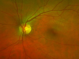 Mr Jonathan C. Park is a surgical and retinal specialist and provides vitrectomy and intra-vitreal injections. Mr Jonathan Park - Specialist Cataract Surgery & Eye Care Nuffield Health, Taunton Hospital 