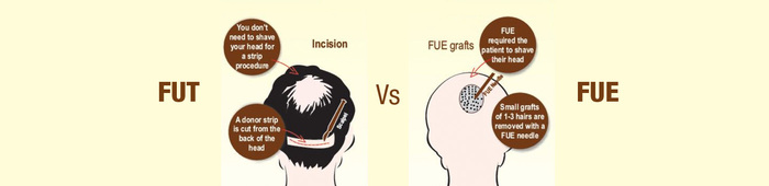  Hair Transplant Clinic of Adron Cosmetic Surgery | Hair Transplant Ahmedabad 1st floor A-wing gold coin ,, opposite jodhpur BRTS stand, Satellite Road, Satellite - Photo 5 of 8