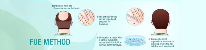  Hair Transplant Clinic of Adron Cosmetic Surgery | Hair Transplant Ahmedabad 1st floor A-wing gold coin ,, opposite jodhpur BRTS stand, Satellite Road, Satellite - Photo 6 of 8