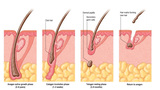 Adron Cosmetic Surgery | Hair Transplant Ahmedabad, Ahmedabad