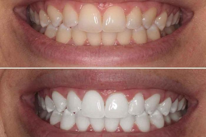  New Album of Porcelain Veneers Dental Center Brooklyn 2384 Ocean Ave #220 - Photo 1 of 5