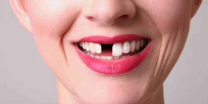  New Album of Porcelain Veneers Dental Center Brooklyn 2384 Ocean Ave #220 - Photo 5 of 5