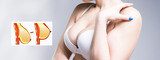 Breast Lift with Fat Transfer in Dubai, Dubai