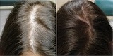 Sani PRP Hair MD, Los Gatos