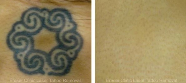  Profile Photos of Eraser Clinic Laser Tattoo Removal 6624 N Riverside Dr #320 - Photo 10 of 10