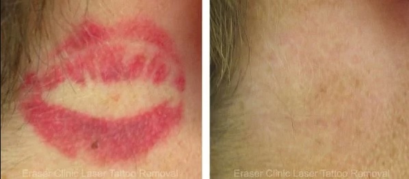  Profile Photos of Eraser Clinic Laser Tattoo Removal 6624 N Riverside Dr #320 - Photo 9 of 10