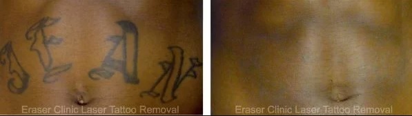  Profile Photos of Eraser Clinic Laser Tattoo Removal 6624 N Riverside Dr #320 - Photo 4 of 10