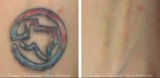  Eraser Clinic Laser Tattoo Removal 6624 N Riverside Dr #320 