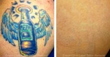  Eraser Clinic Laser Tattoo Removal 6624 N Riverside Dr #320 