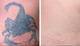  Eraser Clinic Laser Tattoo Removal 6624 N Riverside Dr #320 