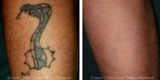 Eraser Clinic Laser Tattoo Removal 6624 N Riverside Dr #320 
