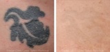  Eraser Clinic Laser Tattoo Removal 6624 N Riverside Dr #320 