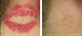  Eraser Clinic Laser Tattoo Removal 6624 N Riverside Dr #320 
