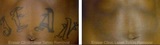  Eraser Clinic Laser Tattoo Removal 6624 N Riverside Dr #320 