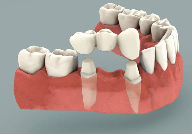  Dental Clinic in Mogappair of Dental Implants in Chennai No:20 AB,Kanishk complex, Panner Nagar Main Road,VGP Nagar, Mogappair - Photo 6 of 7